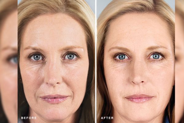 بر خلاف فیلرها نتیجه Sculptra بسیار تدریجی بوده و نیاز به دو و یا سه بار تزریق می باشد.