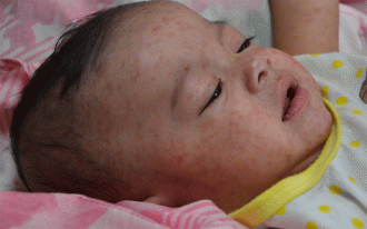 علاپم سرخک measles بین هفت تا ۱۸ روز بعد از تماس ظاهر می شوند